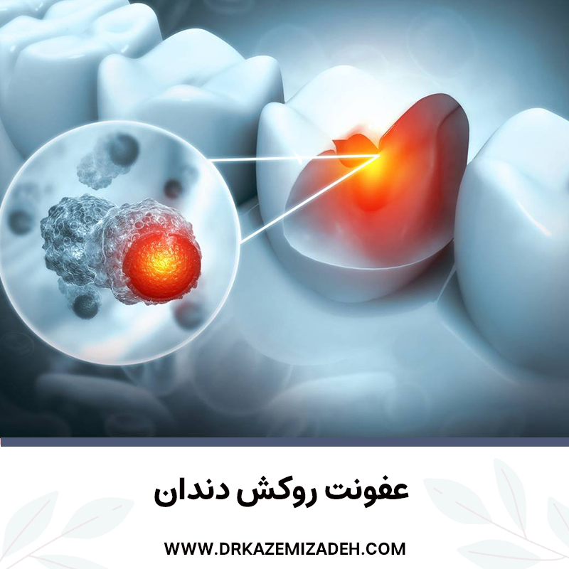 عفونت روکش دندان | دکتر سپیده کاظمی زاده در اصفهان