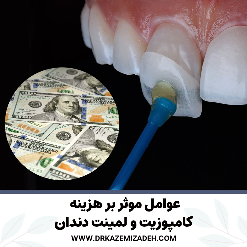 عوامل موثر بر هزینه روکش کامپوزیت و لمینت دندان | دکتر سپیده کاظمی زاده در اصفهان