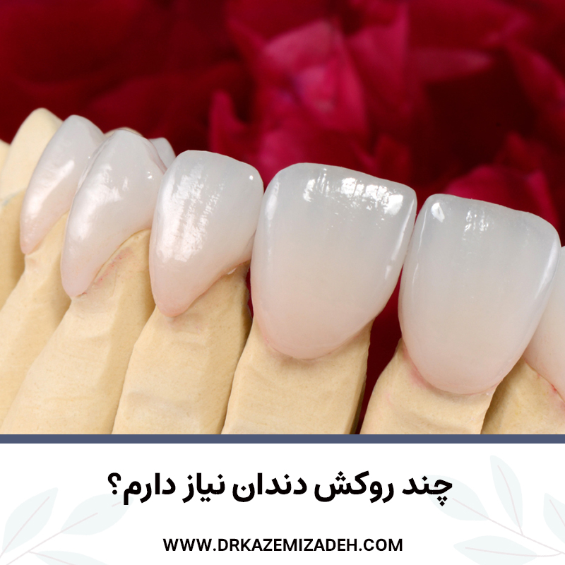 چند روکش دندان نیاز دارم؟ | دکتر سپیده کاظمی زاده در اصفهان