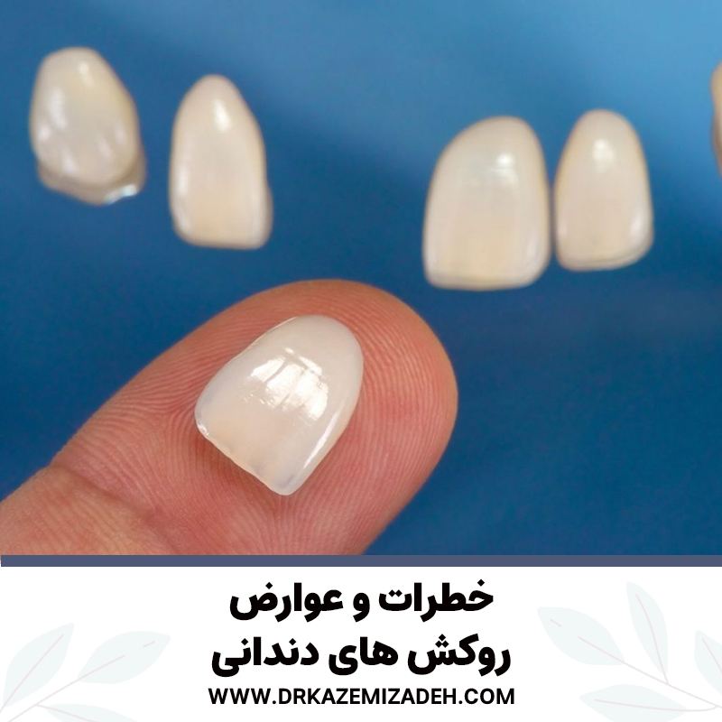 خطرات و عوارض پنهان روکش های دندانی | دکتر سپیده کاظمی زاده در اصفهان