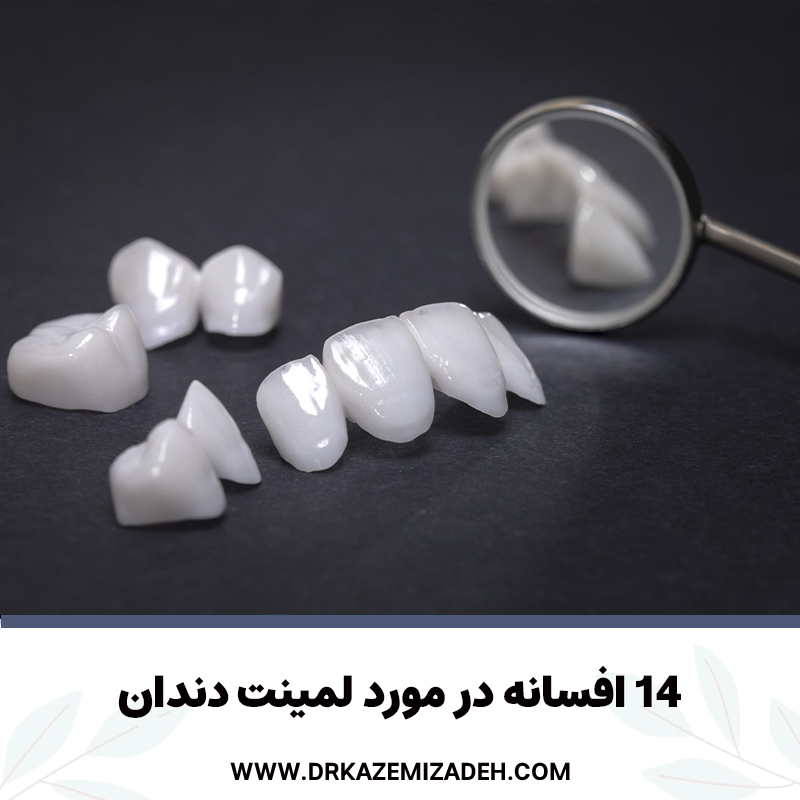 14 افسانه در مورد لمینت دندان | دکتر سپیده کاظمی زاده در اصفهان