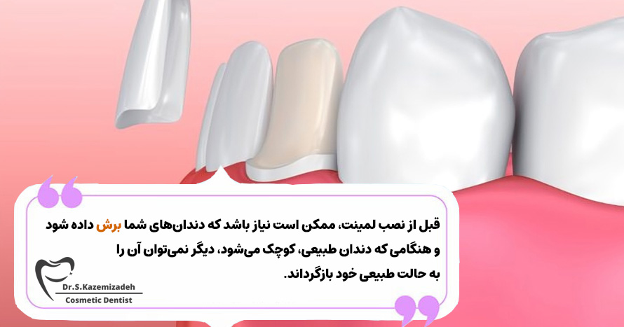 لمینت‌های دندان برگشت‌پذیر هستند | دکتر سپیده کاظمی زاده در اصفهان