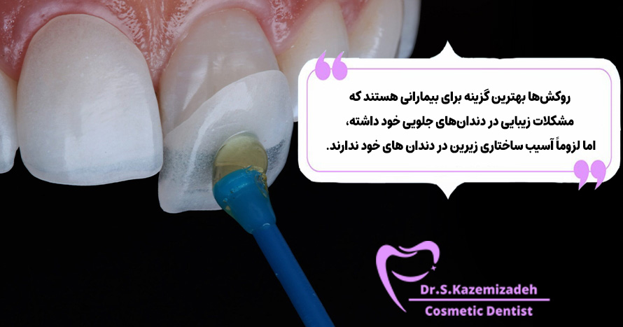 روکش دندان و برتری های آن نسبت به تاج دندان | مطب دکتر سپیده کاظمی زاده