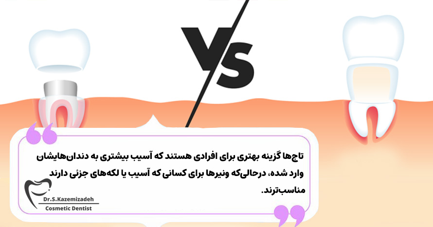 تفاوت بین ونیر و تاج | دکتر سپیده کاظمی زاده در اصفهان