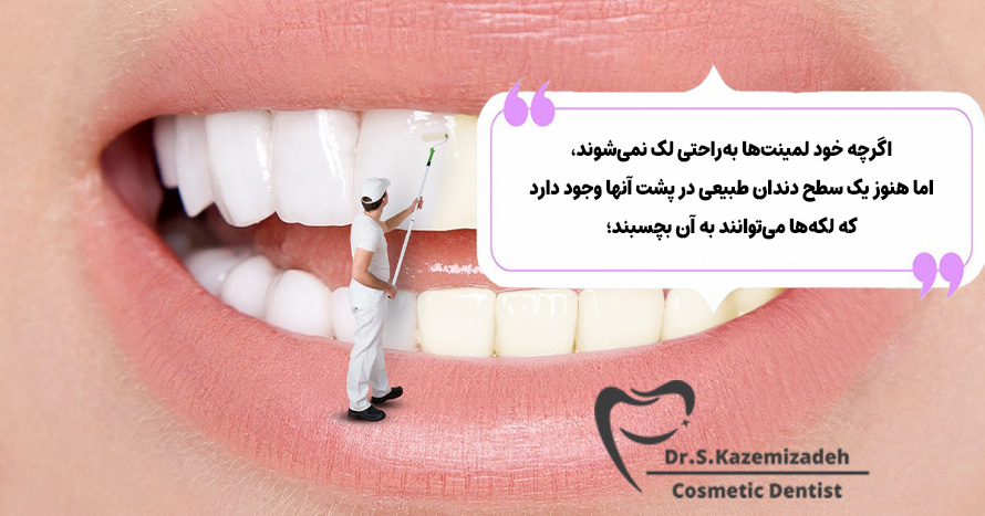 لمینت‌های دندان به‌راحتی لکه می‌شوند؟ | باور های غلط درباره لمینت دندان
