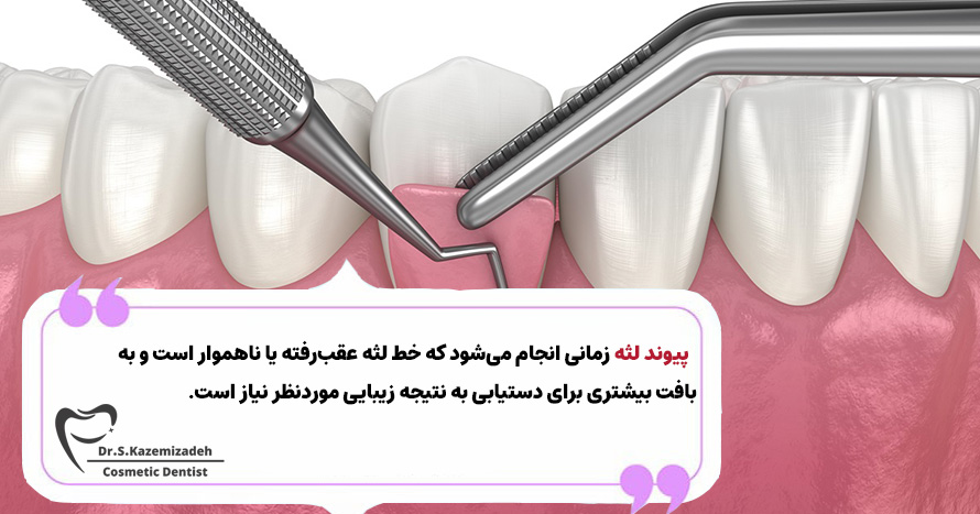 پیوند لثه از جمله روش‌های معمول زیبایی لثه برای ایمپلنت دندان | مطب دندانپزشکی زیبایی دکتر سپیده کاظمی زاده در اصفهان