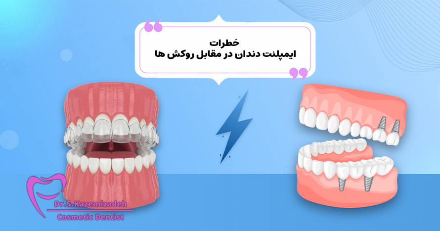 خطرات ایمپلنت دندان در مقابل ونیرها | دکتر سپیده کاظمی زاده در اصفهان
