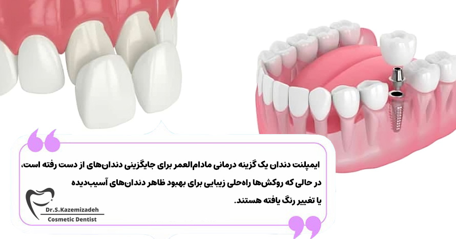 تفاوت بین روکش دندان و ایمپلنت | دکتر سپیده کاظمی زاده در اصفهان