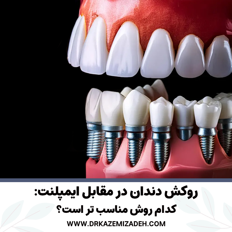 روکش دندان در مقابل ایمپلنت:کدام روش مناسب تر است؟ | دکتر سپیده کاظمی زاده در اصفهان