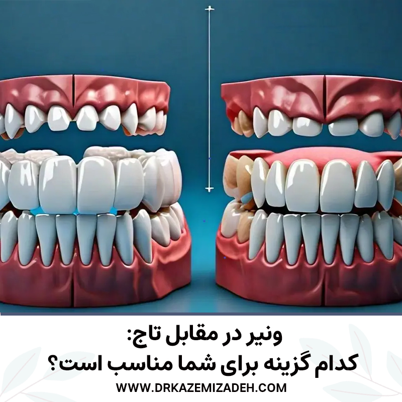 ونیر در مقابل تاج: کدام گزینه برای شما مناسب است؟ | دکتر سپیده کاظمی زاده در اصفهان