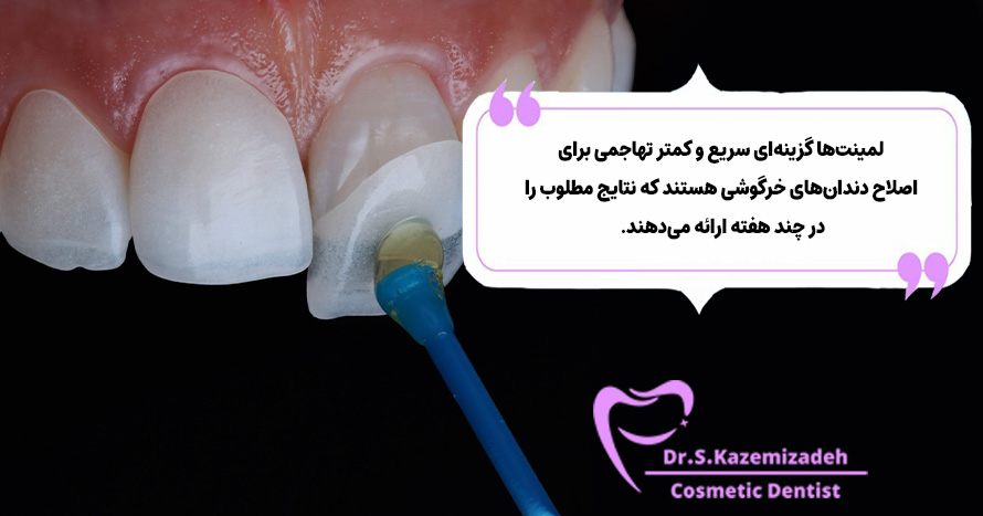 مزایای لمینت دندان‌ خرگوشی | دکتر سپیده کاظمی زاده