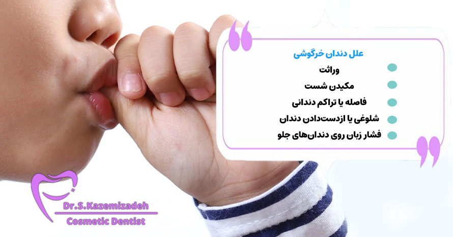 علل دندان خرگوشی جلو | دکتر سپیده کاظمی زاده در اصفهان