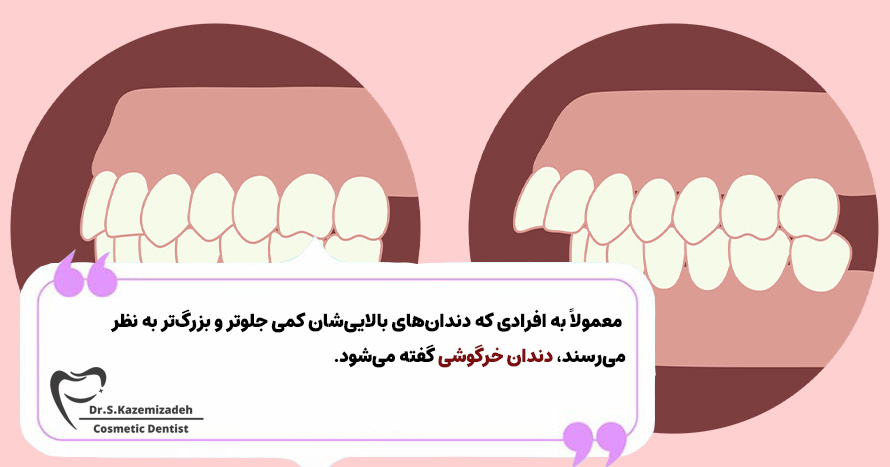 چه زمانی می‌گوییم دندان‌ها خرگوشی هستند؟ | دندان خرگوشی چیست؟ | دکتر سپیده کاظمی زاده