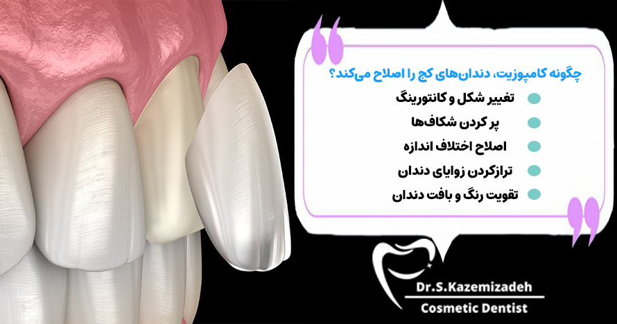 چگونه کامپوزیت، دندان های کج را اصلاح می‌کند؟ | دکتر سپیده کاظمی زاده در اصفهان