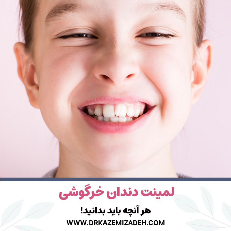 لمینت دندان خرگوشی | هر آنچه باید بدانید! | دکتر سپیده کاظمی زاده در اصفهان