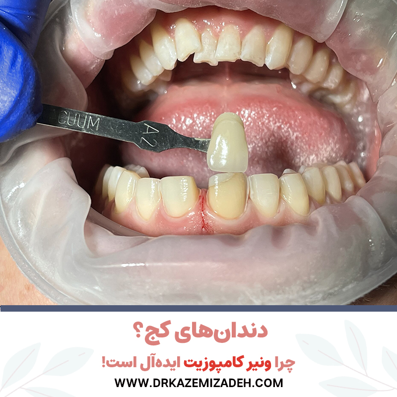 دندان‌های کج؟ چرا ونیر کامپوزیت ایده‌آل است! | دکتر سپیده کاظمی زاده