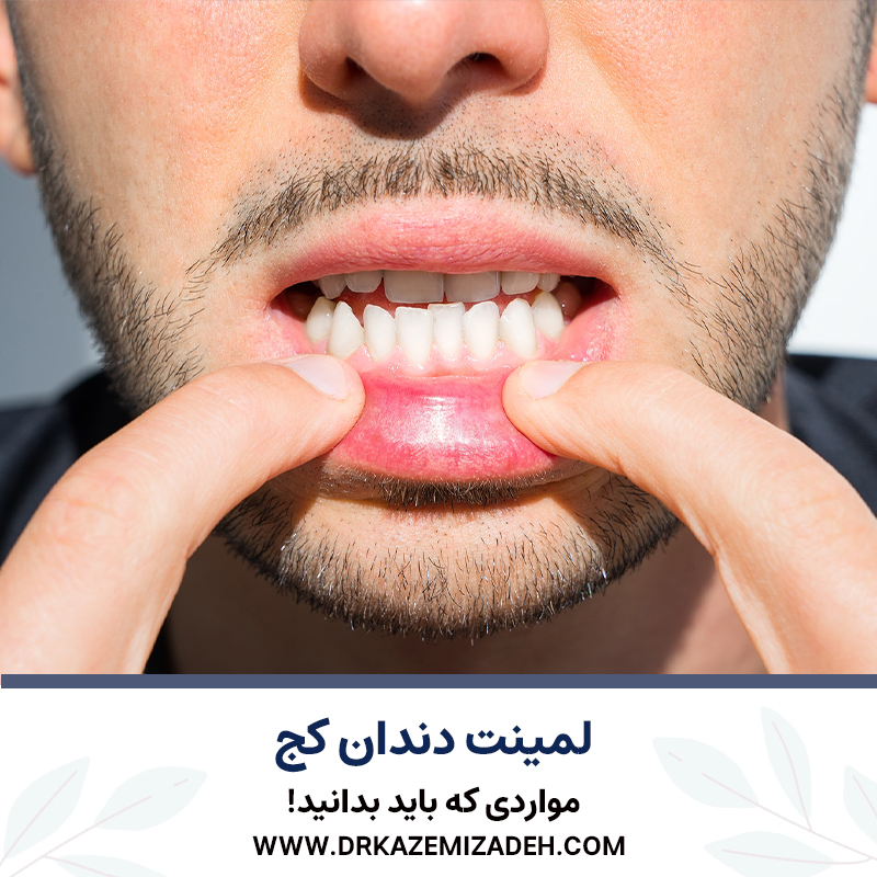 لمینت دندان کج | مواردی که باید بدانید! | دکتر سپیده کاظمی زاده