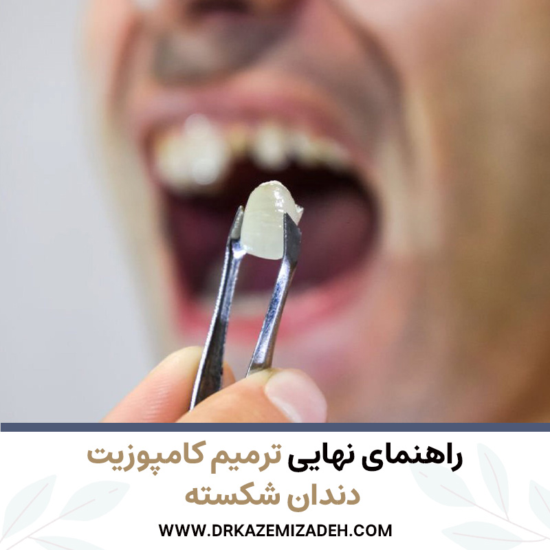 راهنمای نهایی ترمیم کامپوزیت دندان شکسته | دکر سپیده کاظمی زاده در اصفهان