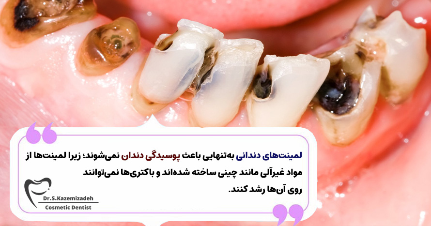آیا لمینت باعث پوسیدگی دندان میشود؟ | دکتر سپیده کاظمی زاده در اصفهان
