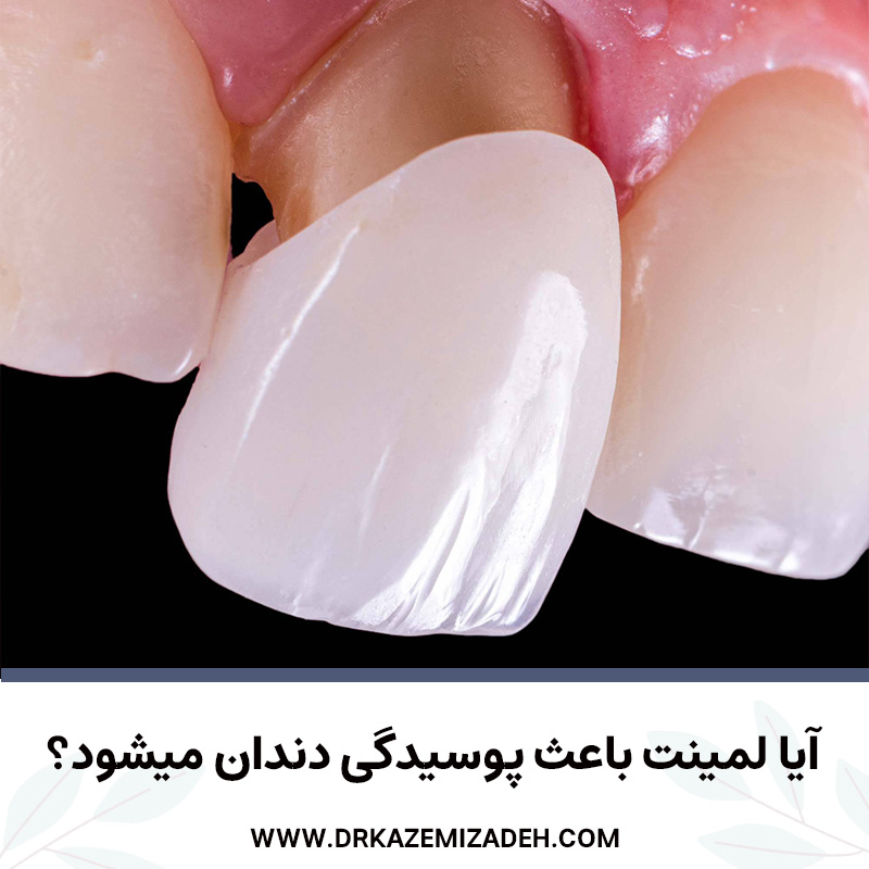 آیا لمینت باعث پوسیدگی دندان میشود؟ | دکتر سپیده کاظمی زاده