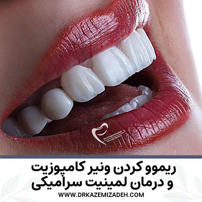 تعویض کامپوزیت‌های قدیمی و نامناسب با لمینیت‌های سرامیکی