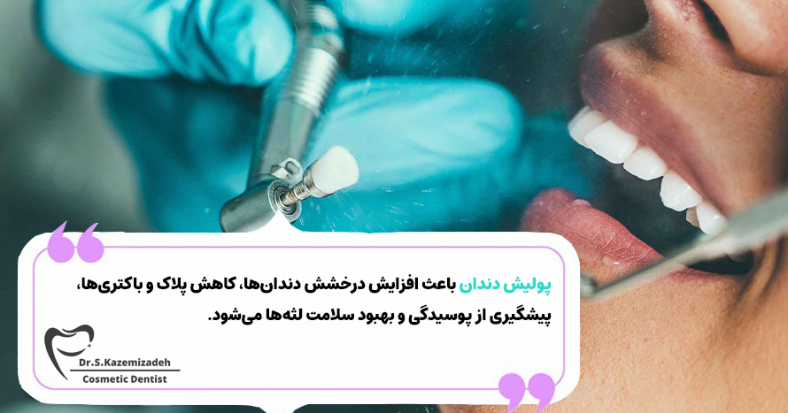 مزایا پولیش دندان | دکتر سپیده کاظمی زاده در اصفهان