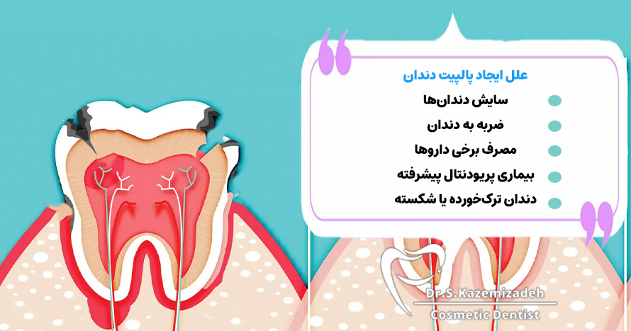 پالپیت دندان چگونه ایجاد می‌شود؟ | دکتر سپیده کاظمی زاده