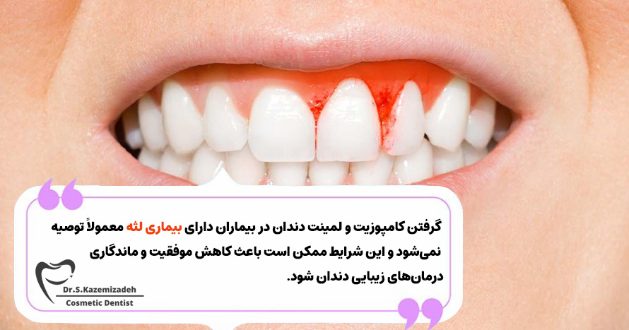 آیا گرفتن کامپوزیت و لمینت دندان با بیماری لثه مناسب است؟ | دکتر سپیده کاظمی زاده