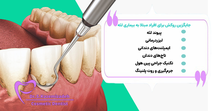 جایگزین‌های روکش برای افراد مبتلا به بیماری لثه | دکتر سپیده کاظمی زاده در اصفهان