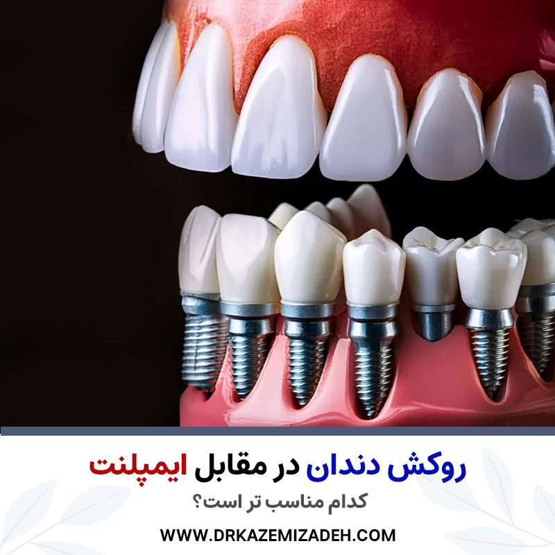 ونیر دندان در مقابل ایمپلنت: روش درمانی مناسب تر | دکتر سپیده کاظمی زاده در اصفهان