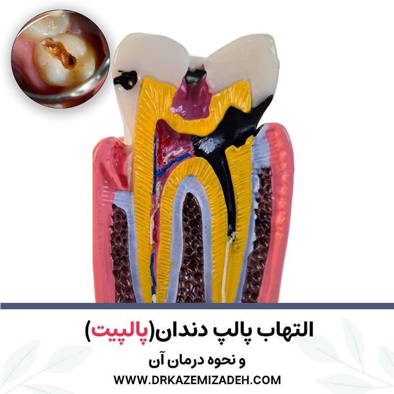پالپیت: التهاب پالپ دندان و نحوه درمان آن | دکتر سپیده کاظمی زاده