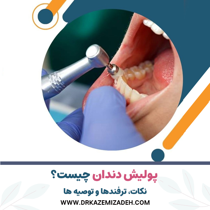پولیش دندان چیست؟ | نکات، ترفندها و توصیه ها | دکتر سپیده کاظمی زاده