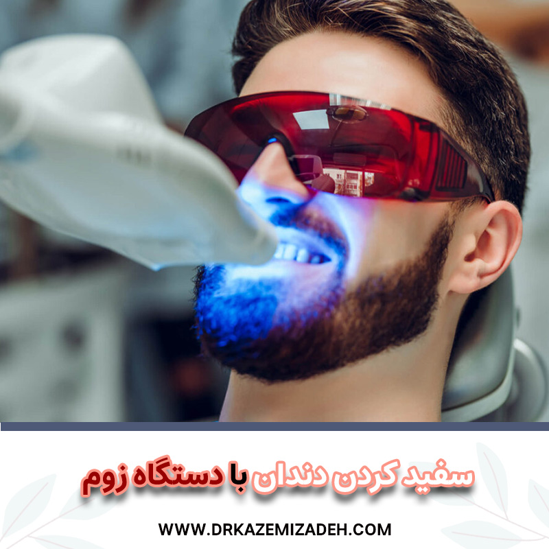 سفید کردن دندان با دستگاه زوم | باید بدانید! | دکتر سپیده کاظمی زاده
