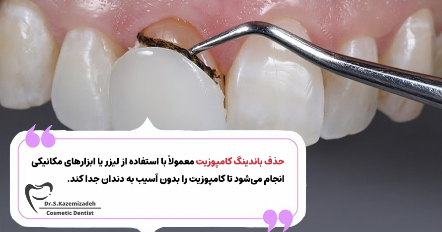 فرایند حذف باندینگ کامپوزیت | دکتر سپیده کاظمی زاده