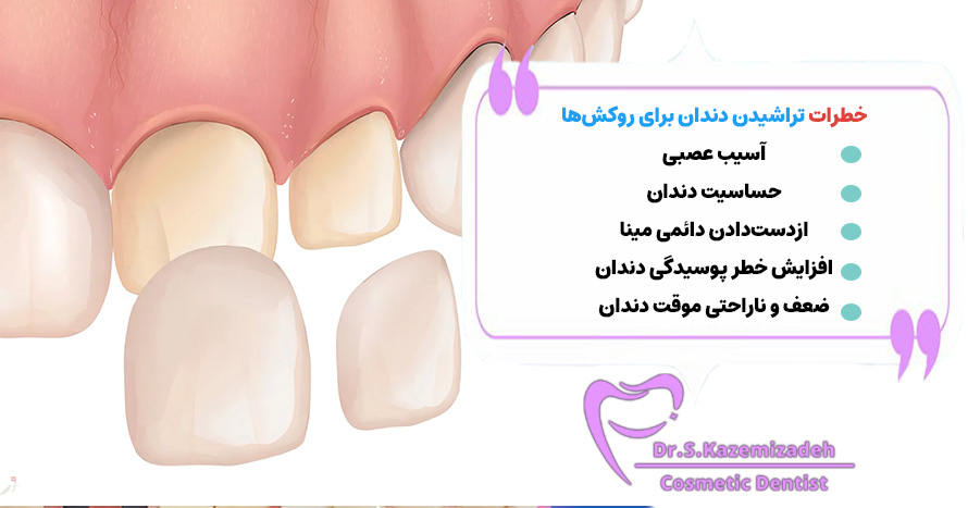 آیا تراشیدن دندان برای روکش‌ها خطراتی دارد؟ | دکتر سپیده کاظمی زاده