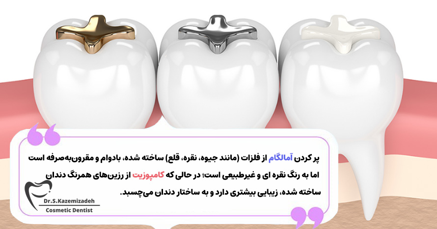 تفاوت بین پر کردن آمالگام و کامپوزیت | دکتر سپیده کاظمی زاده در اصفهان