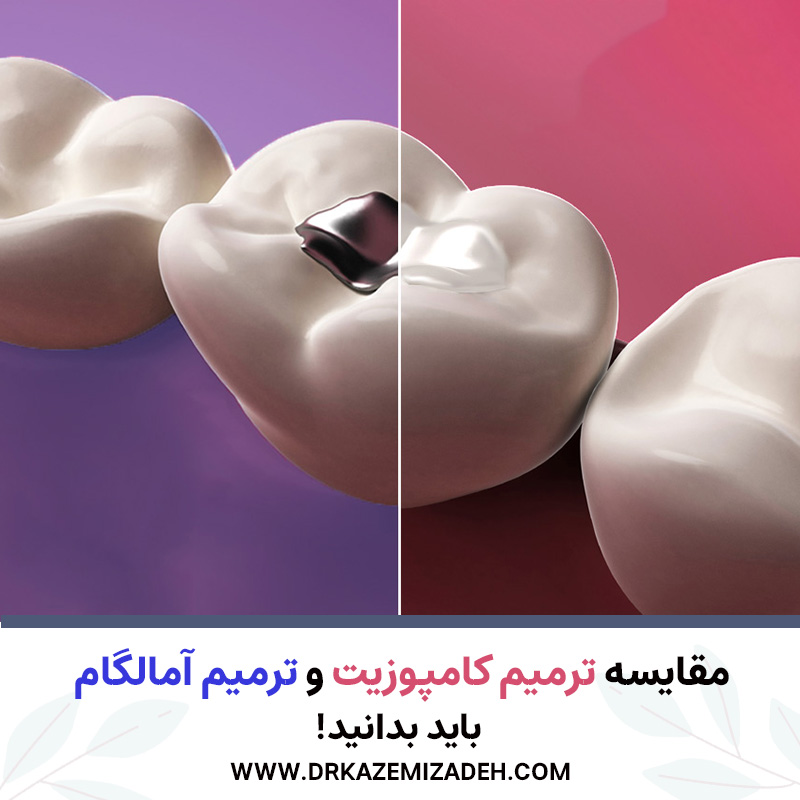 تفاوت بین ترمیم کامپوزیت و ترمیم آمالگام | باید بدانید! | دکتر سپیده کاظمی زاده