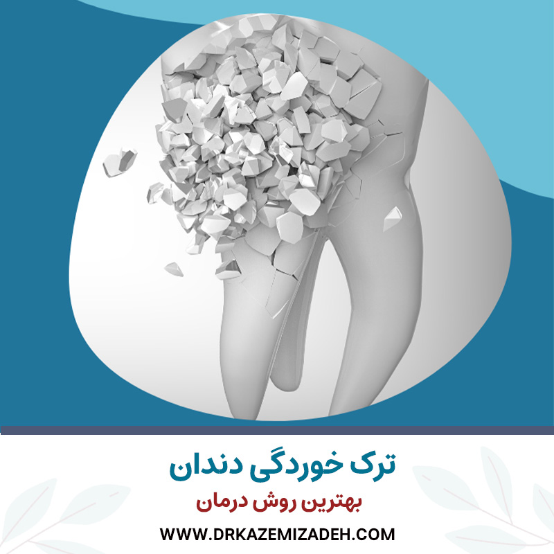 ترک خوردگی دندان | بهترین روش درمان | دکتر سپیده کاظمی زاده در اصفهان