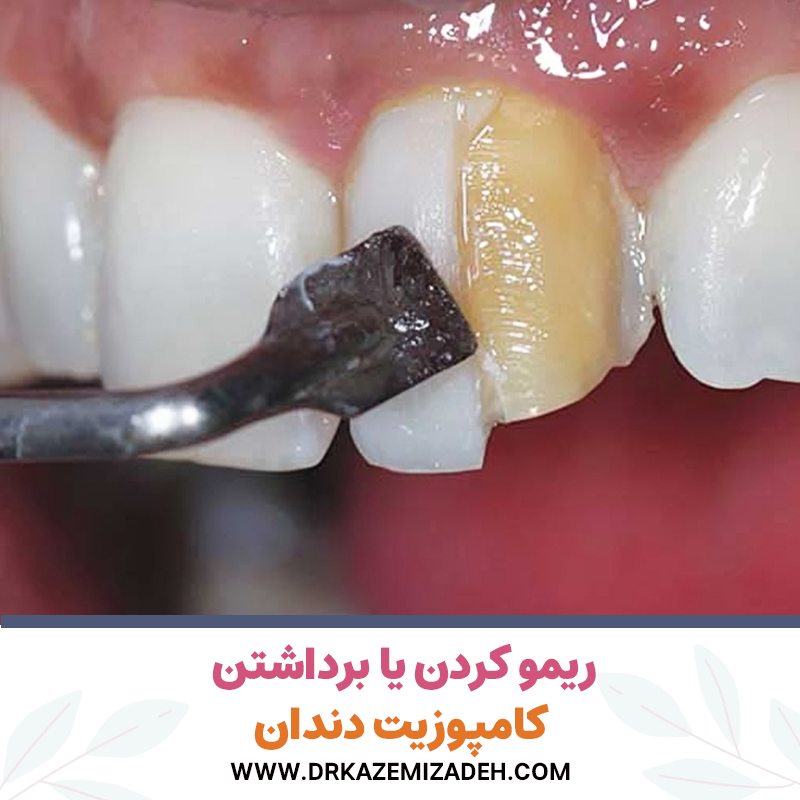 ریمو کردن یا برداشتن کامپوزیت دندان | دکتر سپیده کاظمی زاده