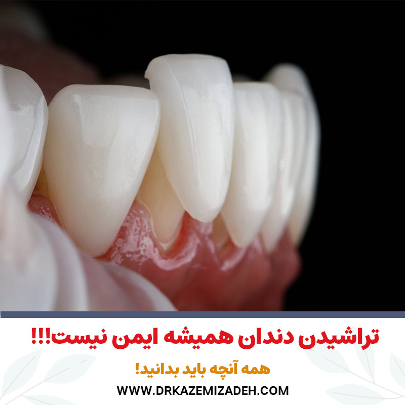 تراشیدن دندان همیشه ایمن نیست | همه آنچه باید بدانید! | دکتر سپیده کاظمی زاده در اصفهان