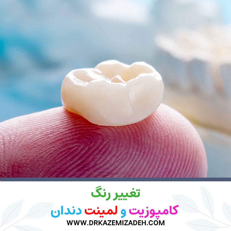 تغییر رنگ روکش دندان | باید بدانید! | دکتر سپیده کاظمی زاده در اصفهان