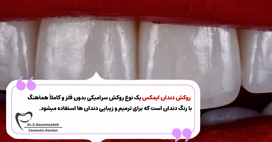 روکش دندان ایمکس چیست؟ | دکتر سپیده کاظمی زاده