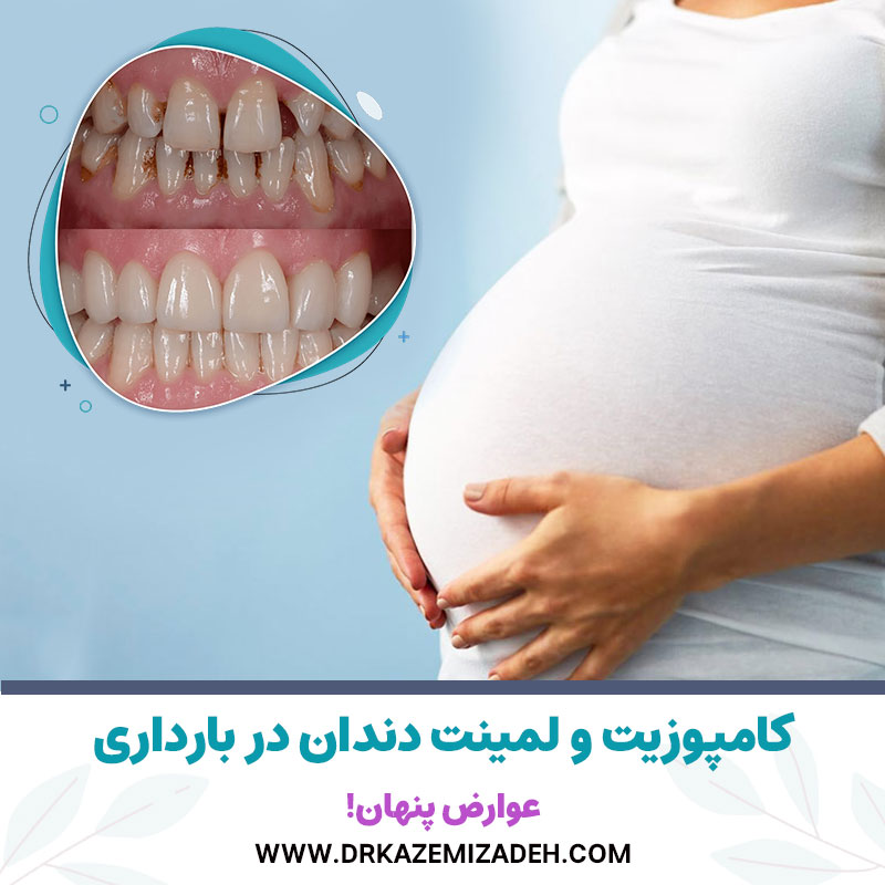 کامپوزیت و لمینت دندان در بارداری | عوارض پنهان | دکتر سپیده کاظمی زاده در اصفهان