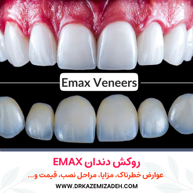همه چیز درباره روکش دندان Emax | عوارض خطرناک ... | دکتر سپیده کاظمی زاده در اصفهان