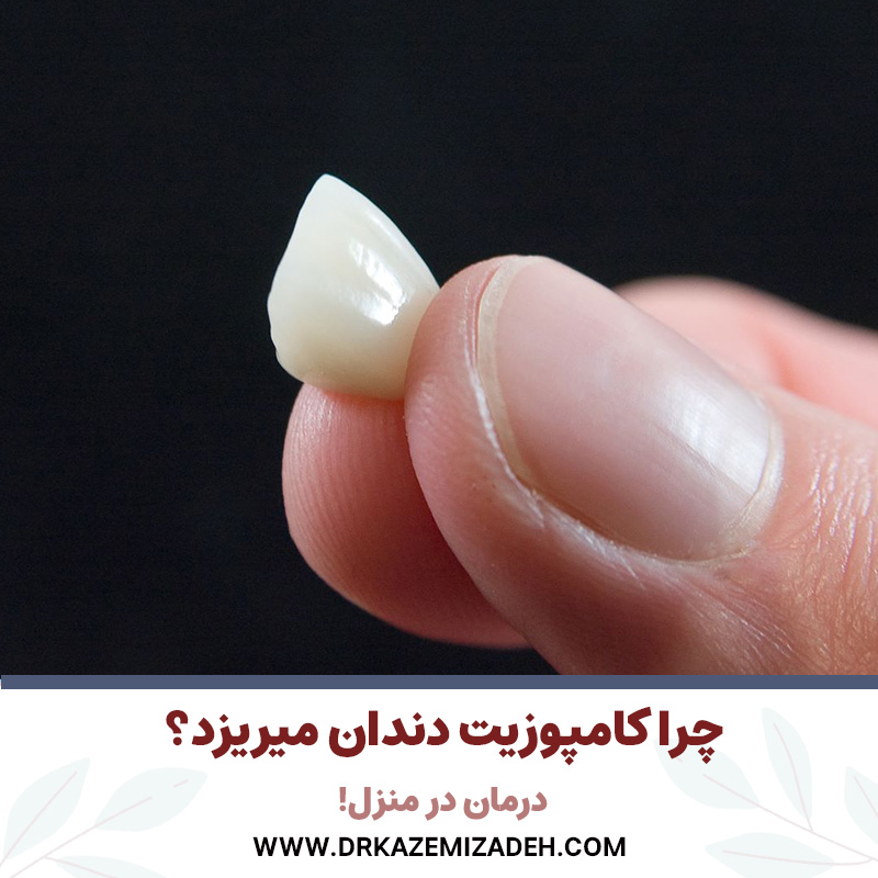 چرا کامپوزیت دندان میریزد؟ | درمان در منزل! | دکتر سپیده کاظمی زاده در اصفهان
