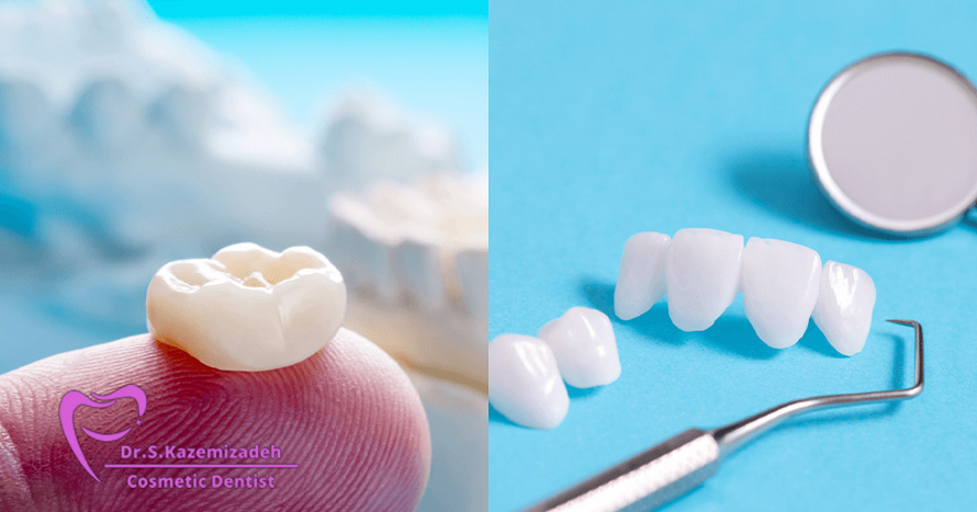 لومینیرز در مقابل ونیرها - تفاوت چیست؟ | مطب دکتر سپیده کاظمی زاده در اصفهان