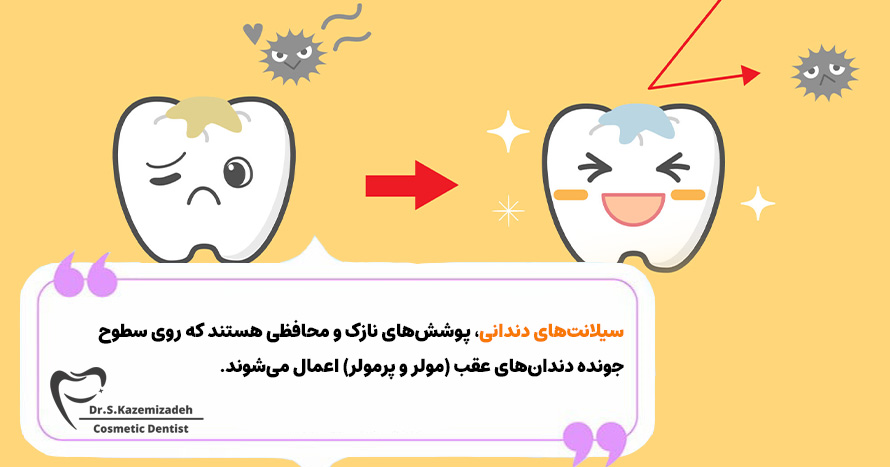 سیلانت‌های دندانی چیستند؟ | دکتر سپیده کاظمی زاده در اصفهان