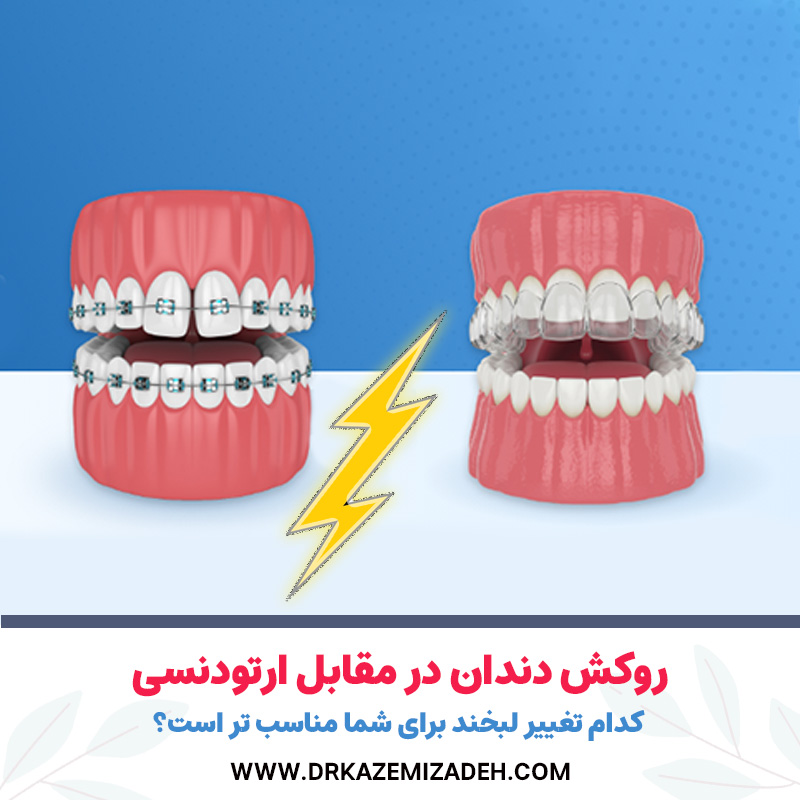 ونیرها در مقابل بریس‌ها: کدام تغییر لبخند برای شما مناسب است؟ | دکتر سپیده کاظمی زاده