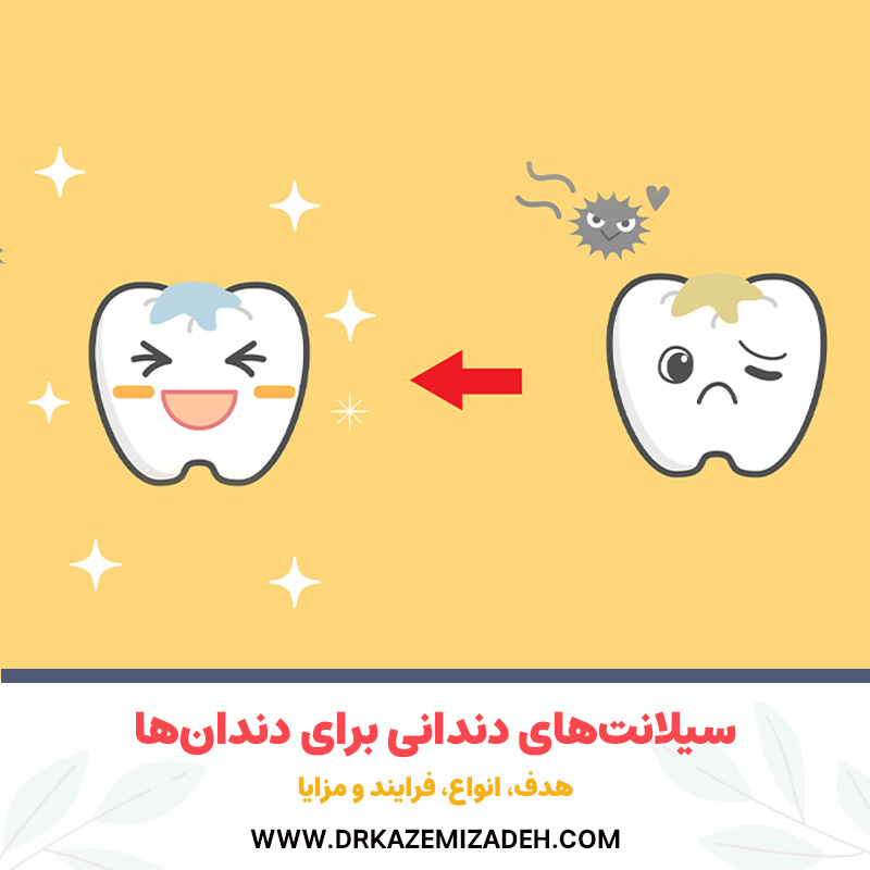 سیلانت‌های دندانی برای دندان‌ها: هدف، انواع، فرایند و مزایا | دکتر سپیده کاظمی زاده